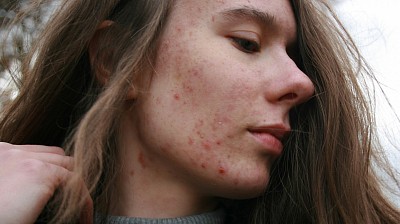 Acne spots on face